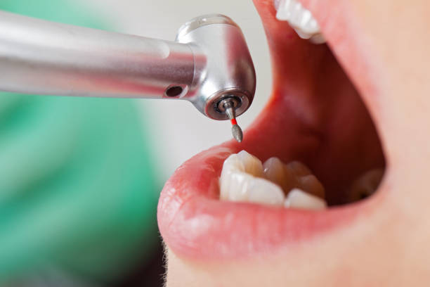Best Emergency Wisdom Teeth Removal in Hamilton Square, NJ